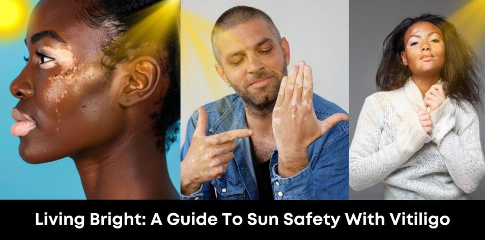 Living Bright- A Guide to Sun Safety with Vitiligo